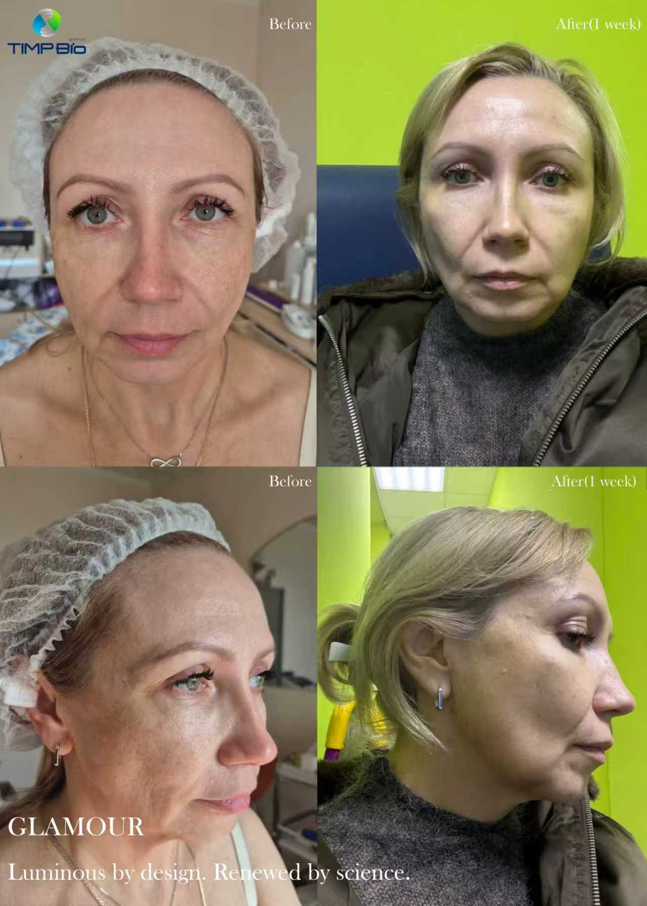 PLLA Glamour: до и после